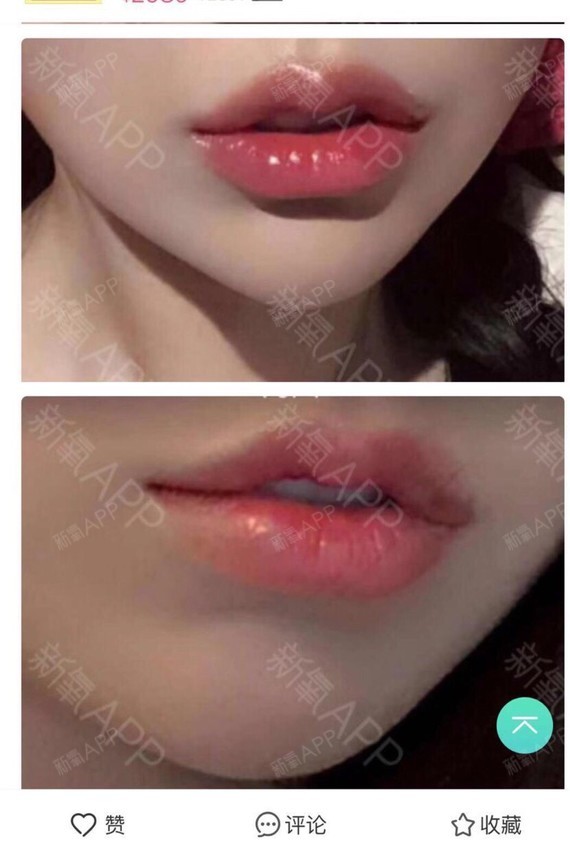 韩国现代美学整形医院##m唇手术/内切埋线人中缩_圈子-新氧美容整形