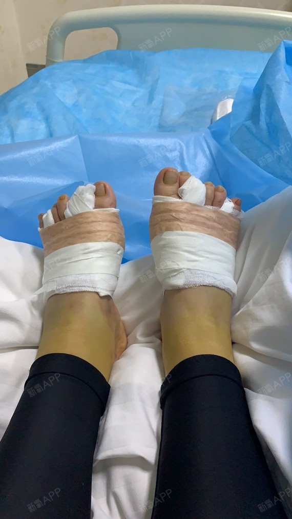 手术是局麻,所以过程中能感受到,心里会紧张,但是打了麻药基本是不疼