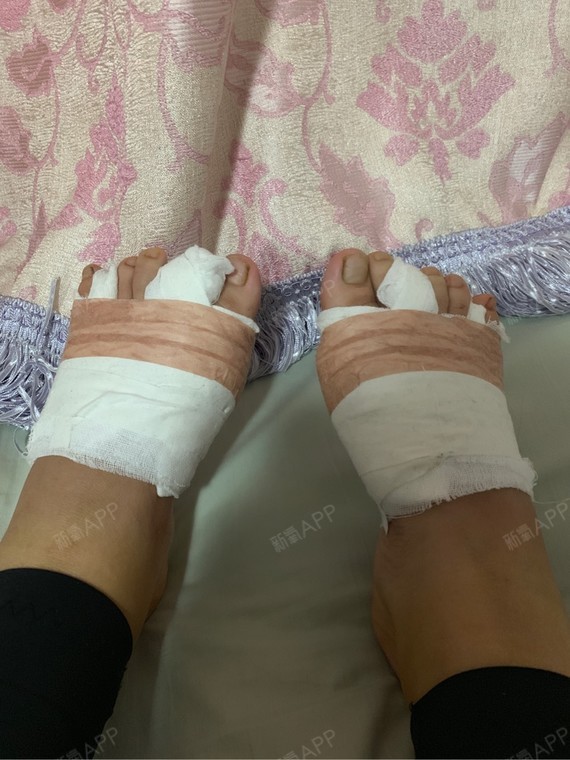 还是肿的很厉害,而且小脚趾那个纱布团太大了,一直顶_圈子-新氧美容