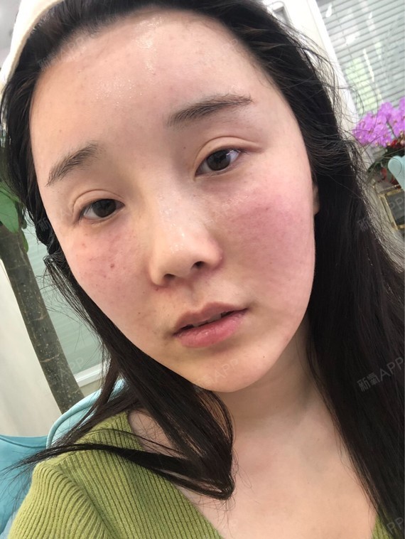 氧气含量百分百水光针第15天美丽日记