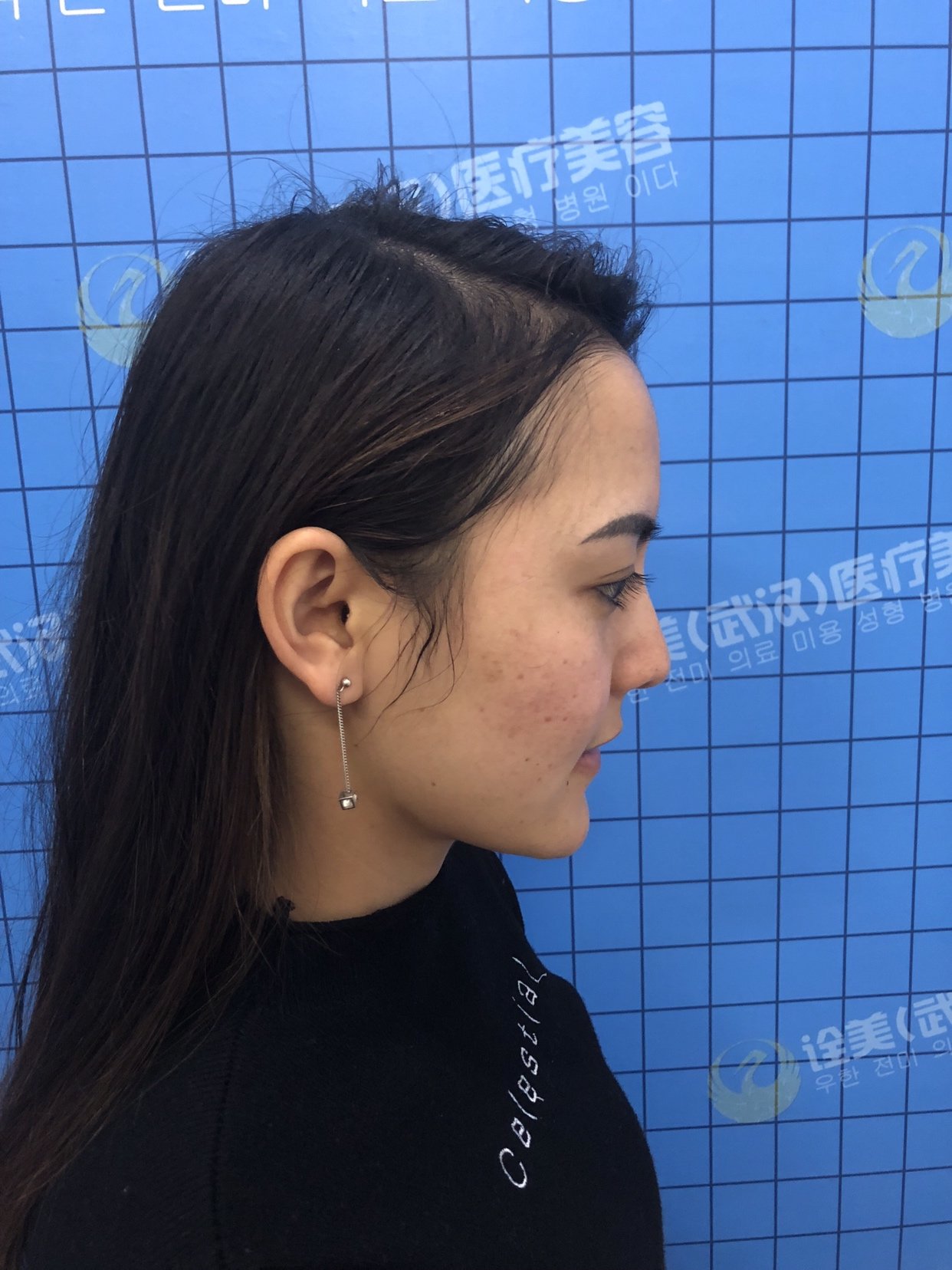 武汉诠美医疗美容门诊部童颜针怎么样_恢复过程_效果如何_遍地花香z9a