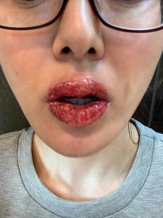 通过新氧消费方案查看半永久纹唇微创轻度疼痛唇型美化