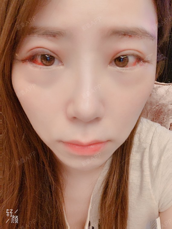 开外眼角好不好_效果图_菲mm开外眼角术后第2天_新氧美容整形