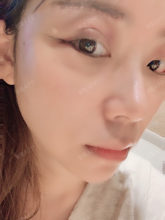 开外眼角