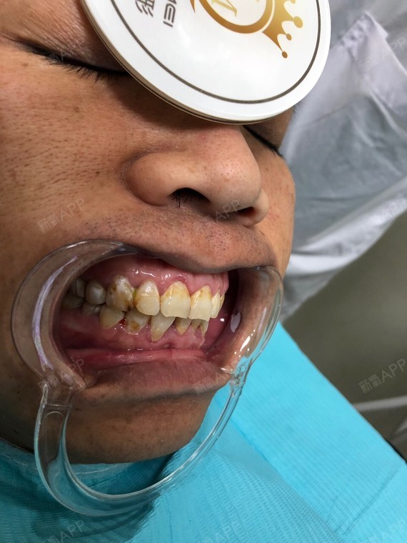 贵州毕节人的牙齿图片图片