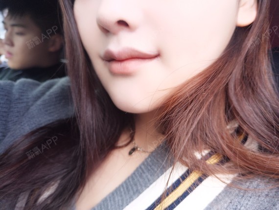 嘴角上扬术后已经半个月了,嘴角恢复的挺顺利的,做了_圈子-新氧美容