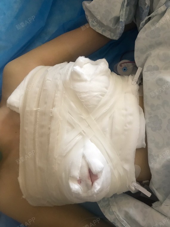 氧气cdf4a21假体隆胸第0天美丽日记