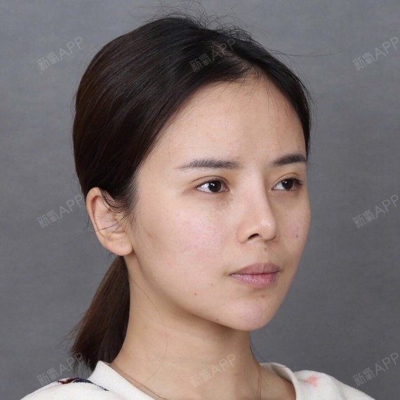 之前做过隆鼻,效果失败了,山根太高太直很假,然后我_圈子-新氧美容