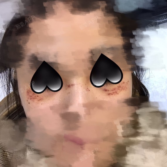 激光祛斑好不好_效果图_小鲸鱼小鲸鱼激光祛