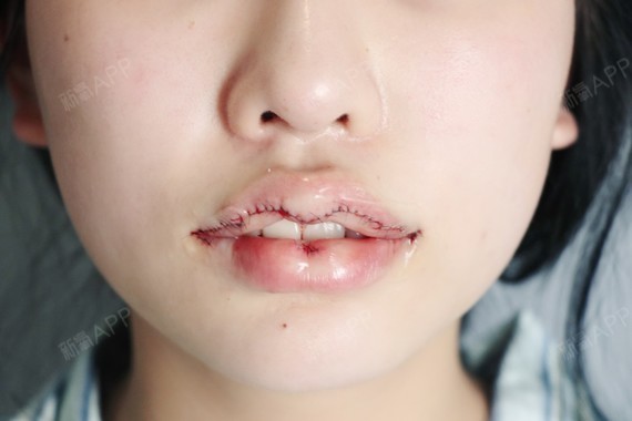 我的嘴巴不好看有2个问题:第一是上颌比较突,所以显_圈子-新氧美容