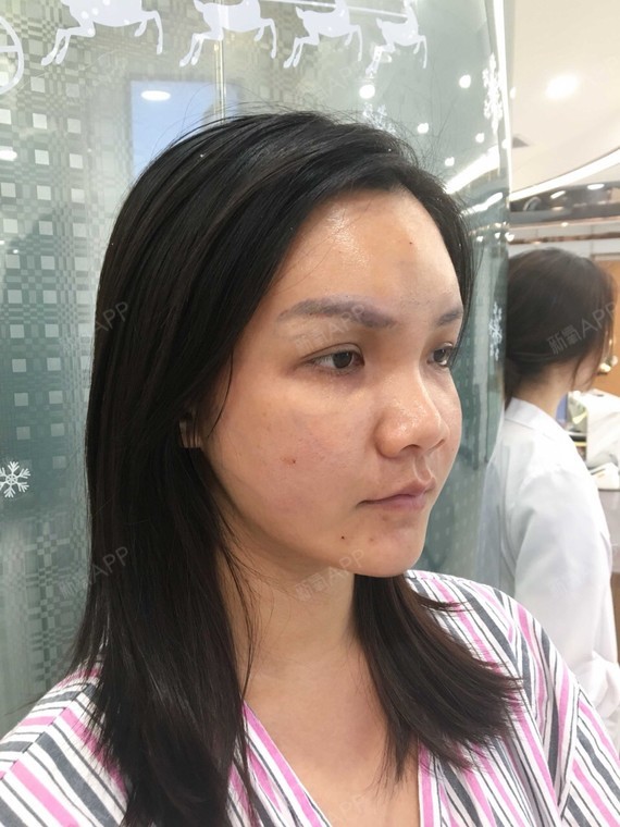 面部凹凸不平显老,为了年轻我选择做自体脂肪填充,快_圈子-新氧美容