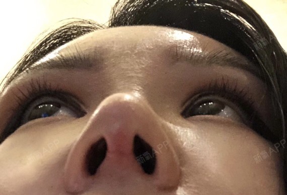 鼻小柱恢复的特别好,现在几_圈子-新氧美容整形