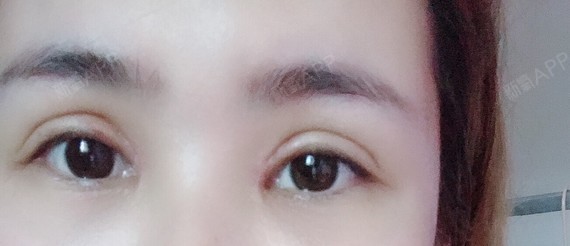 天生三角眼,好了之后应该也是三角眼,做前说是里面小_圈子-新氧美容