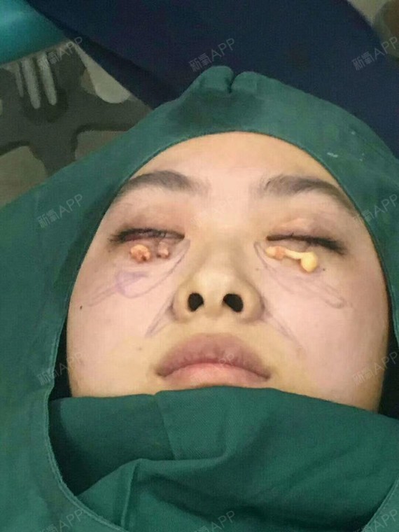 偶然知道了韩国的高益秀院长专做 pan眼袋黑眼圈矫正,去韩国手术