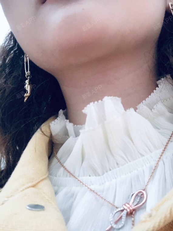 终于拆线了,拆线后下巴看起来还是很自然的,现在看自_圈子-新氧美容