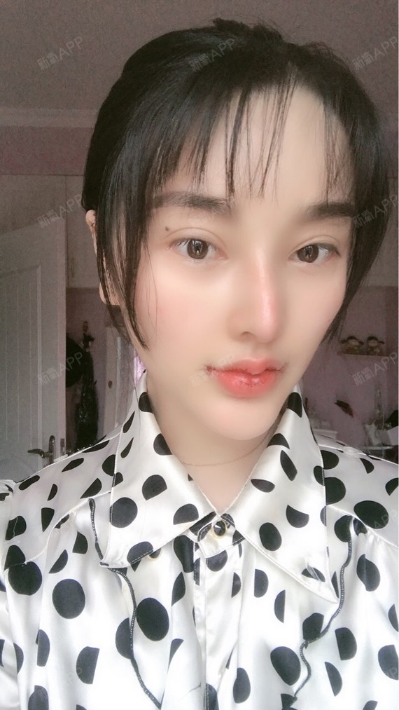 今天是做嘴角上扬的第三天,我感觉术后即刻效果还挺好的,我的嘴巴