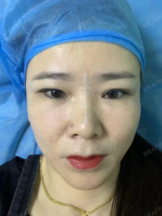 玻尿酸填充卧蚕