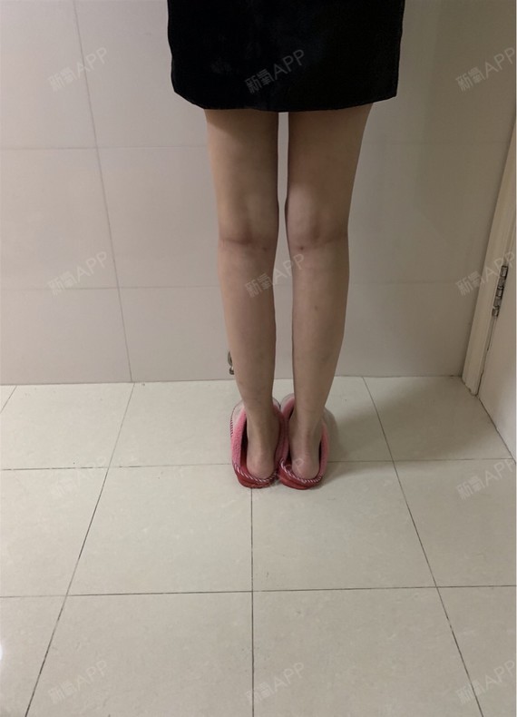 张慧妹妹妹雯雯超声溶脂瘦大腿第136天美丽日记