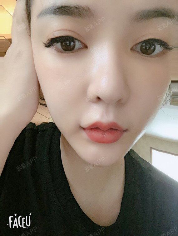 感觉唇珠还是有点太多太大了,跟我预期的自然款有些偏_圈子-新氧美容