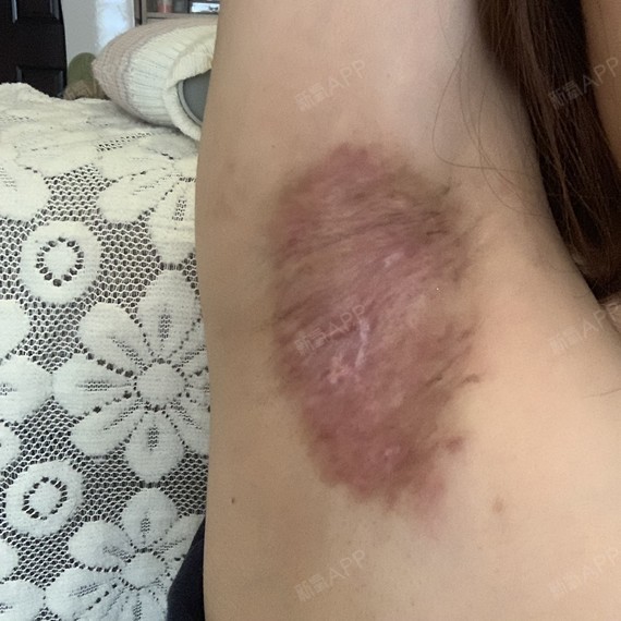 贵阳手术除腋臭好不好_效果图_氧气xjfid手术除腋臭术后第28天_新氧