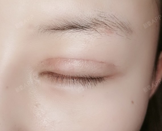 眉弓眉毛伤口 兄弟我又去切双眼皮了牛逼吗 哈哈 圈子 新氧美容整形