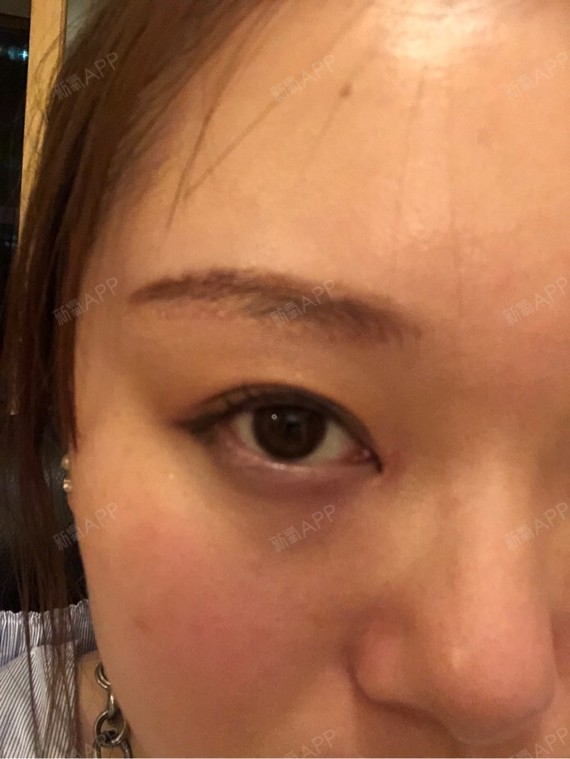 提眉术主要怕术后疤痕,和漫长的恢复期,其实疤痕可以化妆遮盖,术后一