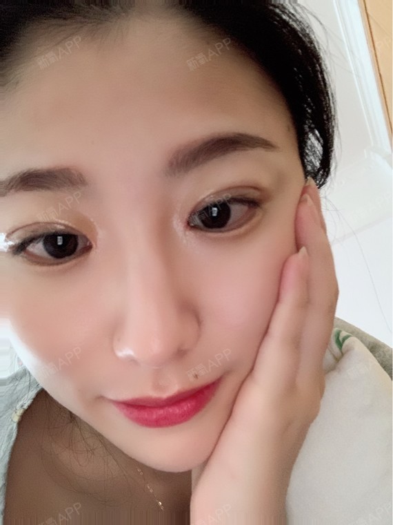 私人定制项目术后第0天 刚做完双眼皮自然效果非常满意.