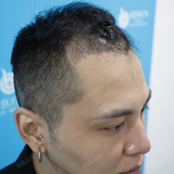 【发际线种植第4天】对于头发来说对我真的很重要,因_圈子-新氧美容