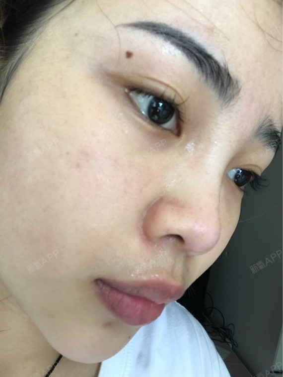 重庆伊肤泉微针好不好_效果图_氧气mes6bfa伊肤泉微针术后第3天_新氧