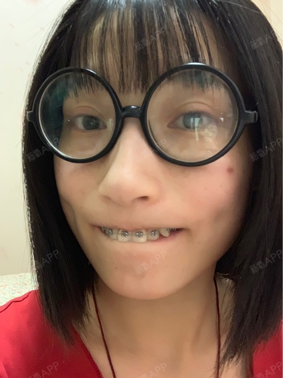 我的牙齿因为牙弓,虎牙还有咬合的原因导致嘴是有点向_圈子-新氧美容
