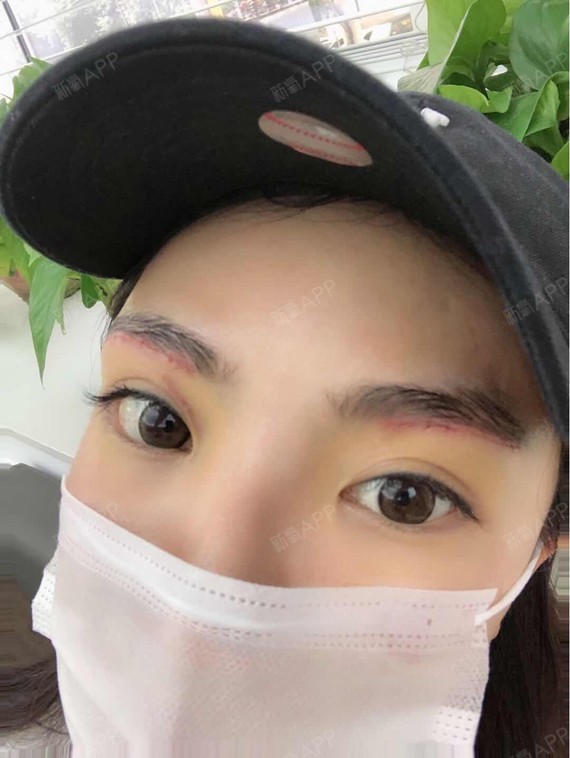 眉弓配合切眉,衬托的眼睛又大又深_圈子-新氧美容整形