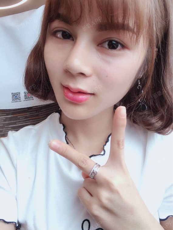 玻尿酸丰唇第二天