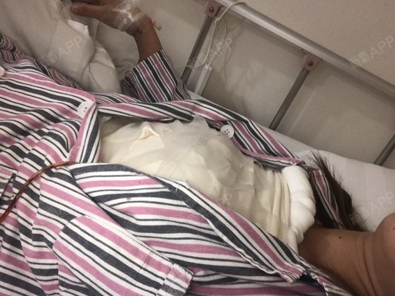 做的是245cc的曼托水滴形假体,感觉没大多少呢,_圈子-新氧美容整形