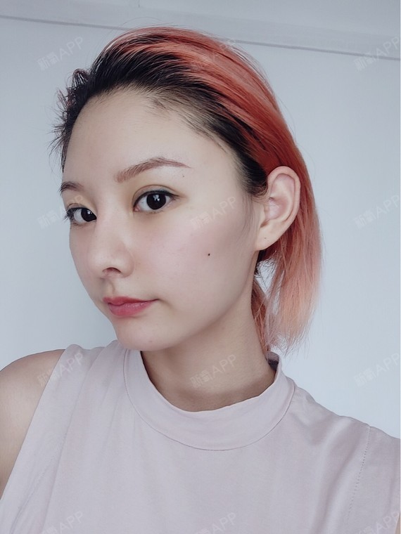 下巴可以自由自在的摸,很自然,不管是外观还是感觉,_圈子-新氧美容