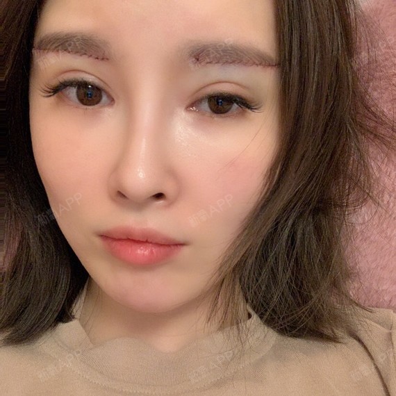 切眉术后第三天!记录一下