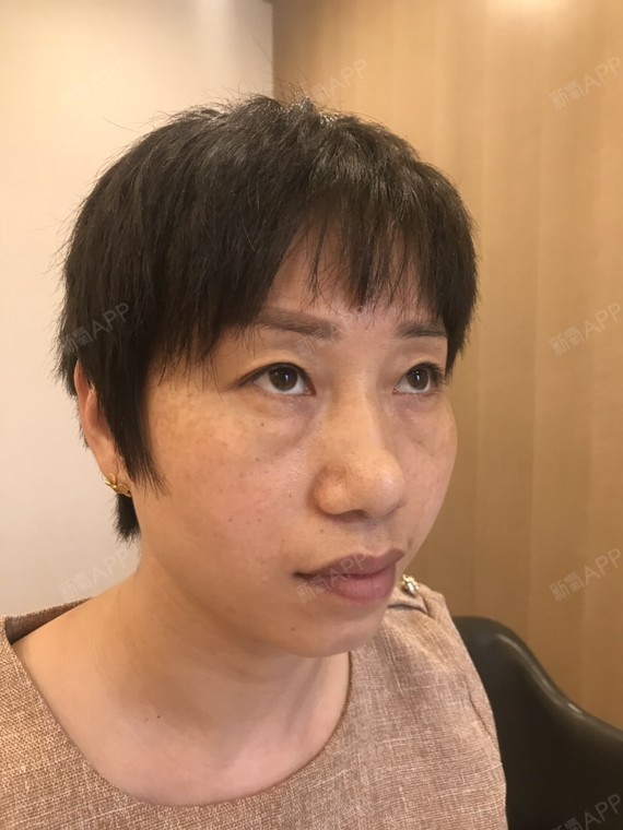 我是天生的眼袋大,从小就有眼袋的.