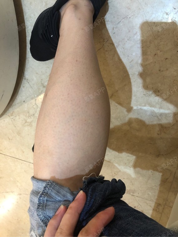 这是打瘦腿针之前的照片我先记录下来以后有个对比