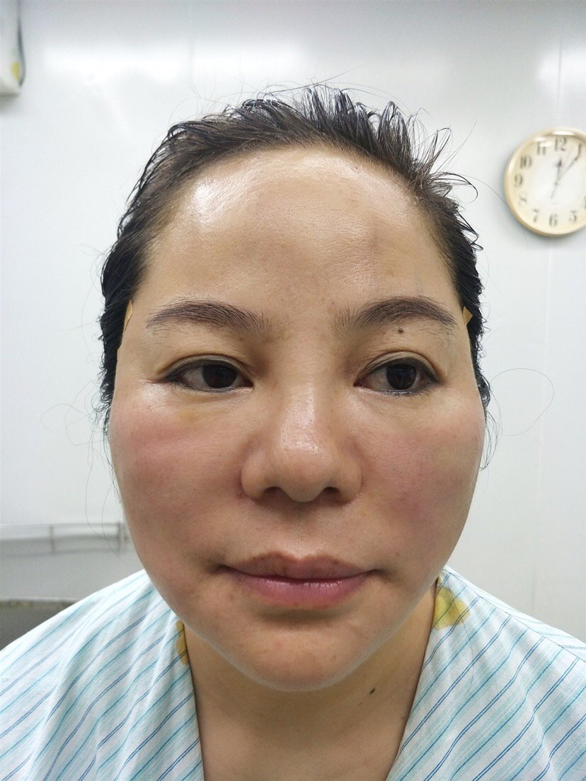 面部线雕一个月