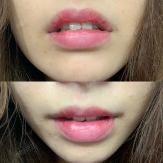 厚唇改薄好不好_效果图_氧气xjfid厚唇改薄术后第96天_新氧美容整形