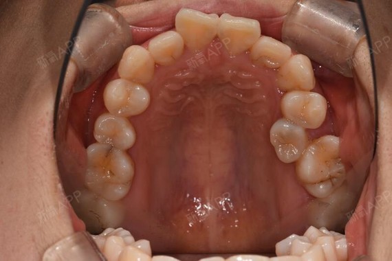 牙齿一直比较拥挤08,下前牙被支持挤歪了,上面门牙有_圈子-新氧美容