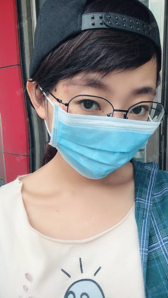 激光祛斑好不好_效果图_尘世无情u激光祛斑术