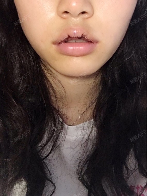 我比较喜欢自然的唇形,和医生说不要唇珠太尖,我不要_圈子-新氧美容