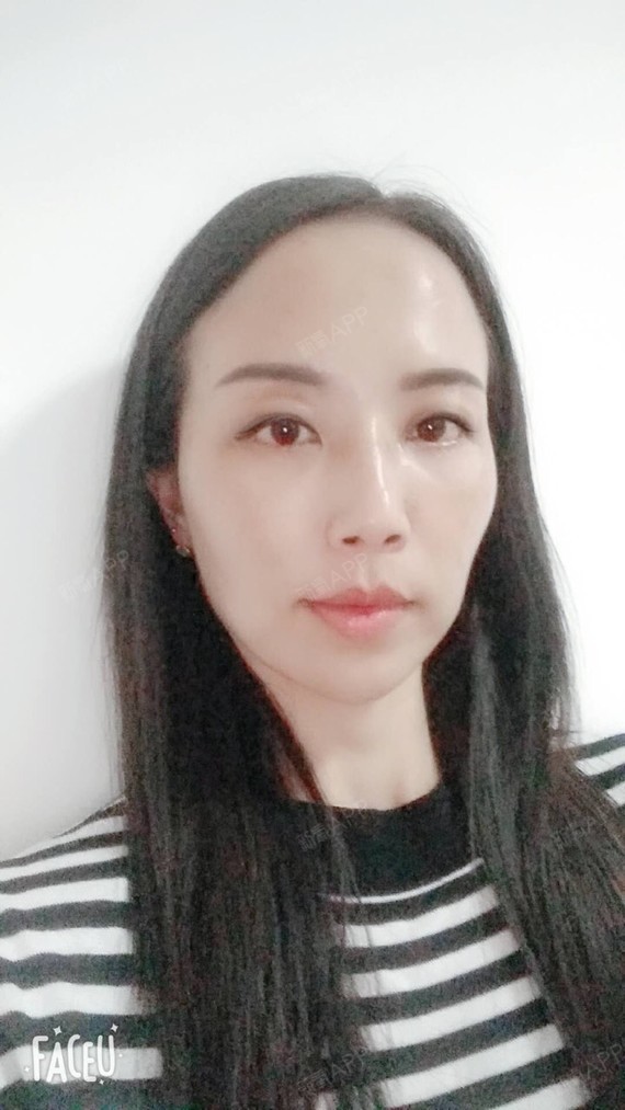 今天术后第五天了,已经没有多大感觉了,脸紧绷了很多,提升效果