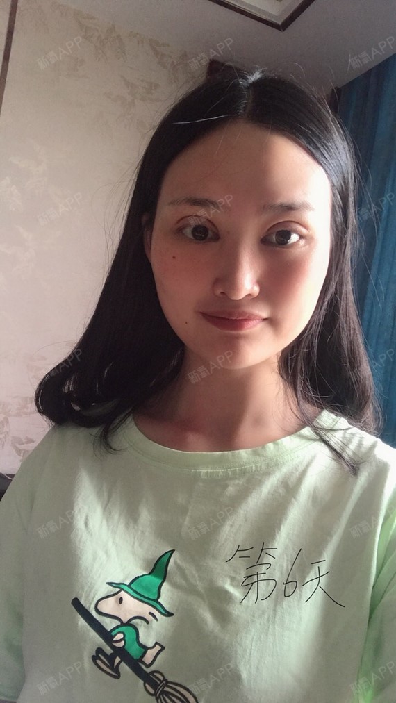 开内眼角
