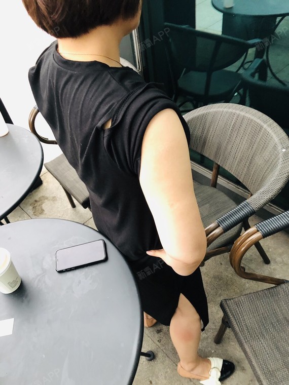 日子过得好快啊,今天术后60天,天气热了,手臂细了_圈子-新氧美容整形