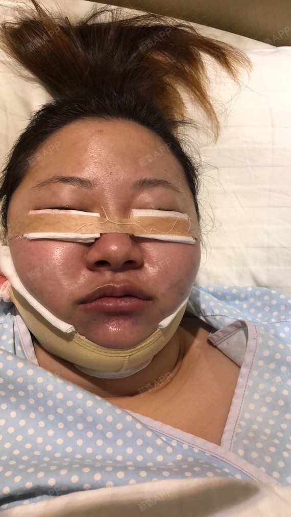 【眼袋内吸 下颌缘吸脂】手术当天