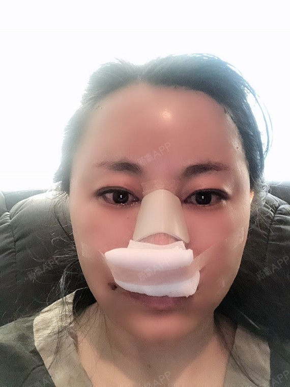 手术很顺利,不过鼻子塞着纱布的感觉不好受.