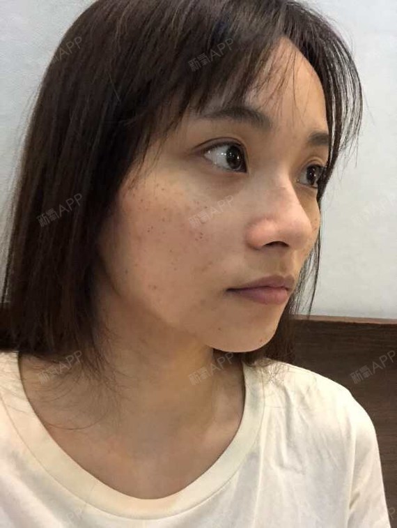 我的颧骨上有很多靑褐色斑,长得_圈子-新氧美容整形
