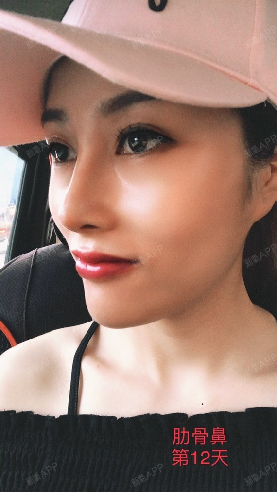 肋骨鼻第12天了!鼻子基本成型咯!