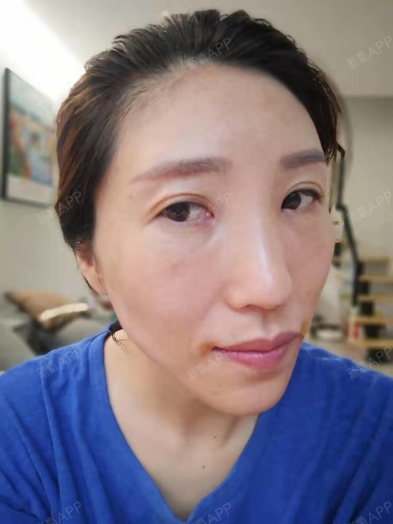 上海眶隔脂肪释放好不好_效果图_青山如故眶隔脂肪释放术后第1天_新氧